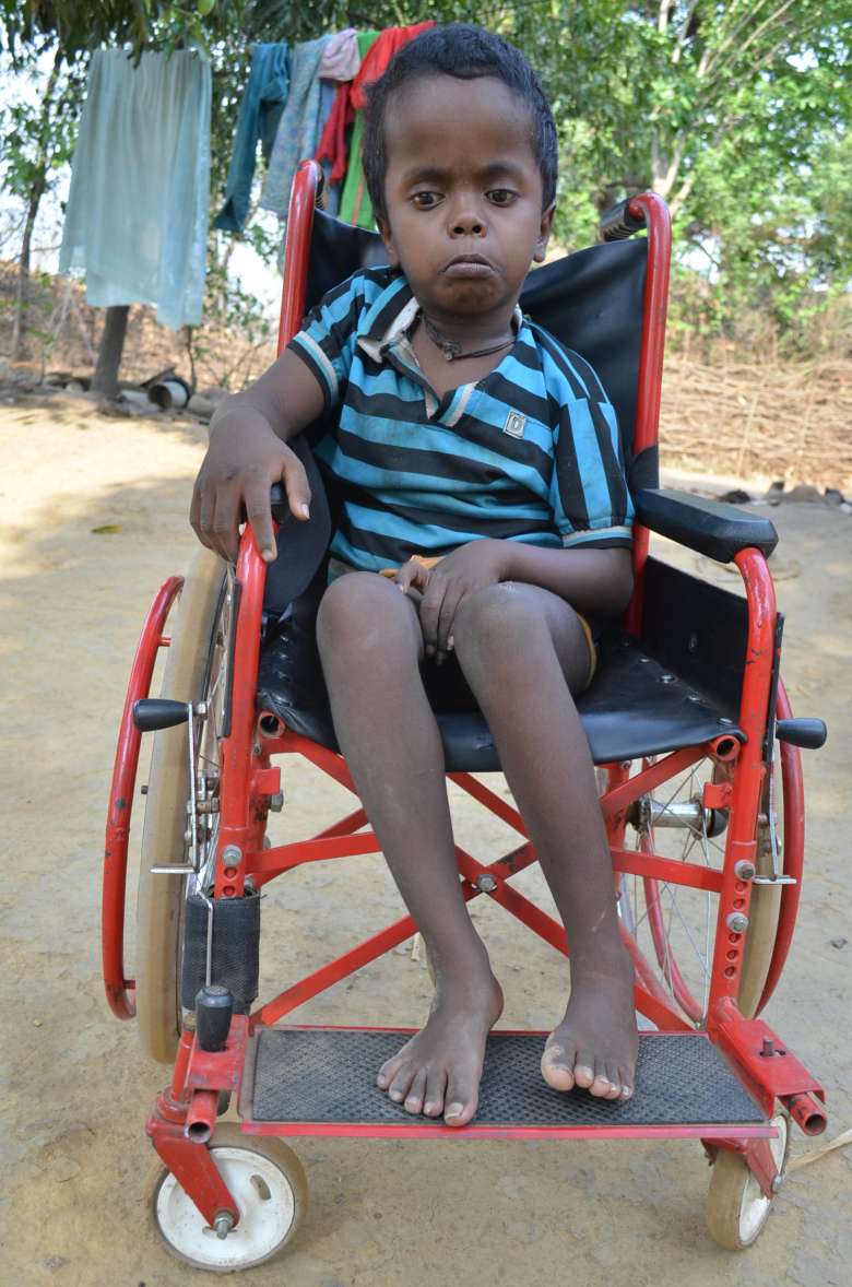Achai Baskey, 12-years-old, from Rajdoha Village, was born with a swollen head and brain damage. His family worries it was connected to the high levels of radiation in the region. UCIL denies it. (Photo: Ashish Birulee)
